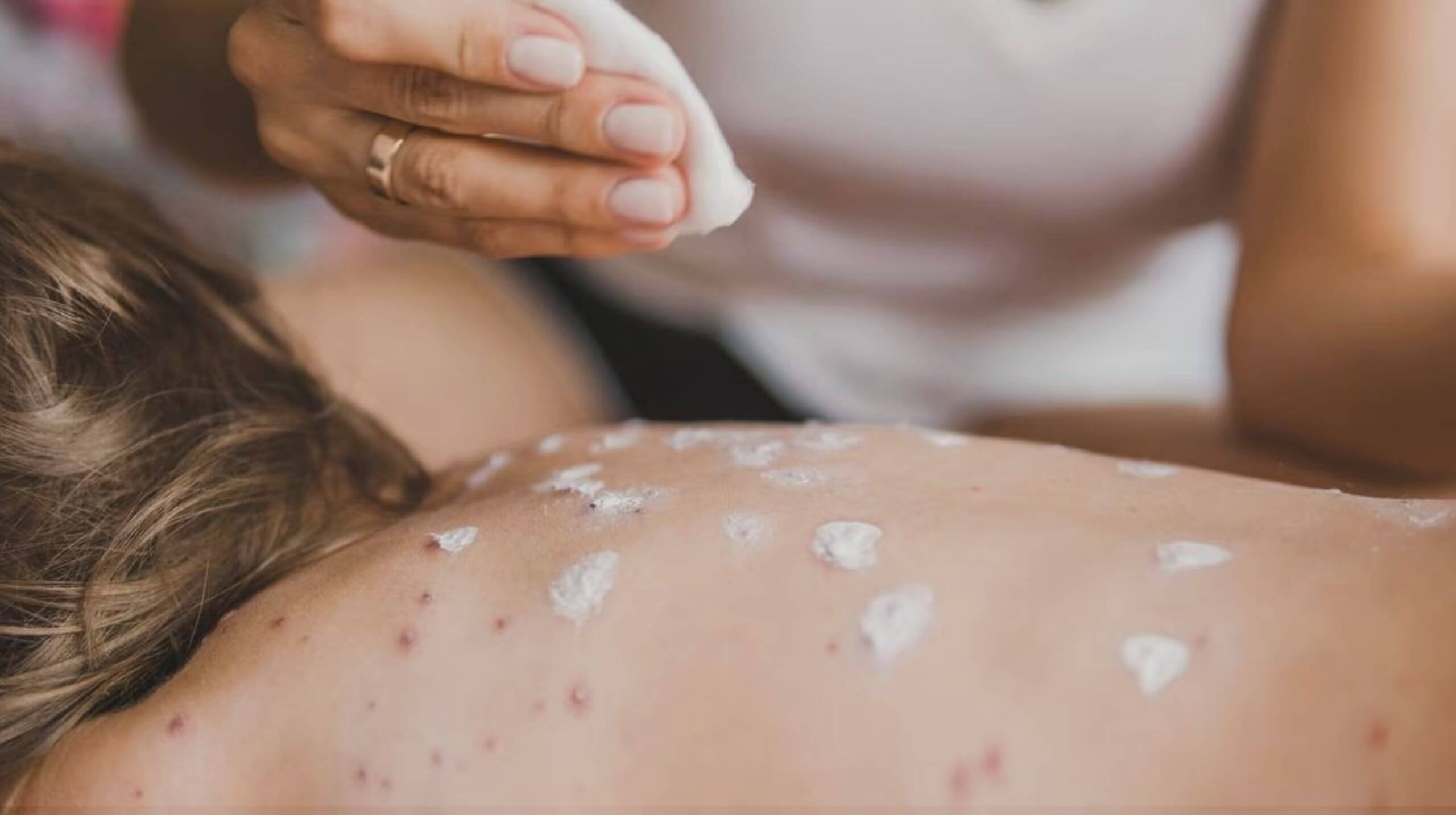 Chickenpox: Diagnosis, Prevention, and Treatment.