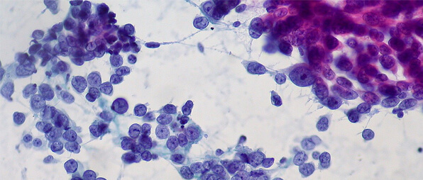 Fluids, Urine, and Effusions Cytology